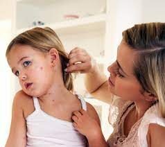 Measles Symptoms & Treatment