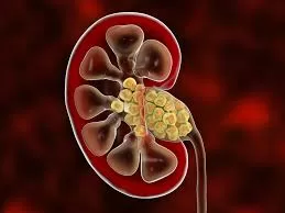 kidney stone formation