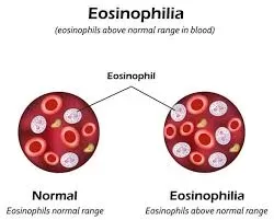 Absolute Eosinophil