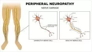 All about Neuropathy and Peripheral Neuropathy