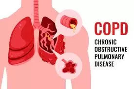 copd symptoms, cause and treatment