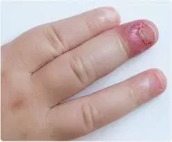 Infected Finger Tip: Causes and Treatment