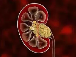 kidneys stones symptoms, Causes & Treatment