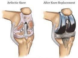 Knee Replacement Surgery Process and Cost