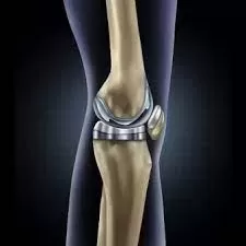 Knee Replacement Surgery Process and Cost