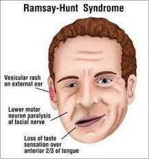 Understanding Ramsay Hunt Syndrome: Causes, Symptoms, and Treatment Options