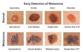 mole to melanoma detection