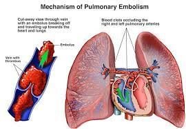 embolism pulmonary disease cause and care
