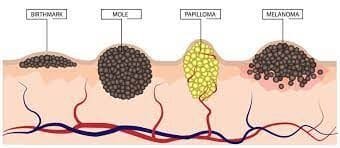 Mole to Melanoma: What You Need to Know