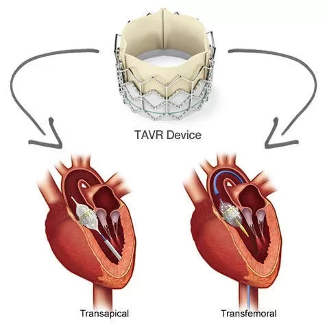 Transcatheter Aortic Valve Implantation (TAVR Heart Surgery) - Symptoms of a Stroke