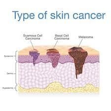 types of skin cancer - Skin Melanoma Cancer: Symptoms, Prevention, and Treatment