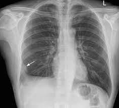 embolism in lung - pulmonary embolism