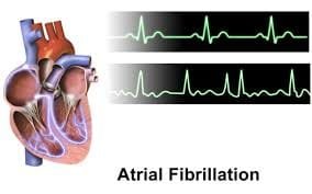 Atrial fibrillation