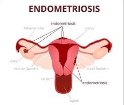 Decoding Endometriosis: Causes, Symptoms, and Effective Management Strategies