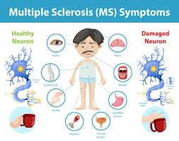 Multiple Sclerosis: Understanding Causes, Symptoms, and Treatment Strategies