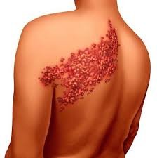 Shingles, also known as herpes zoster