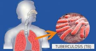 Tuberculosis