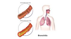 bronchitis