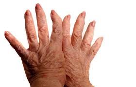 rheumatoid arthritis