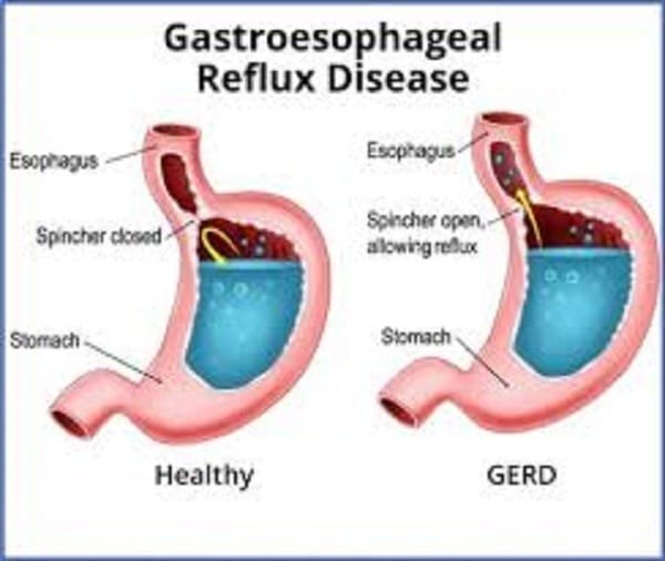 Understanding Gastroesophageal Reflux Disease (GERD)