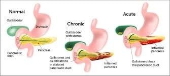 normal to chronic Pancreatic Attack