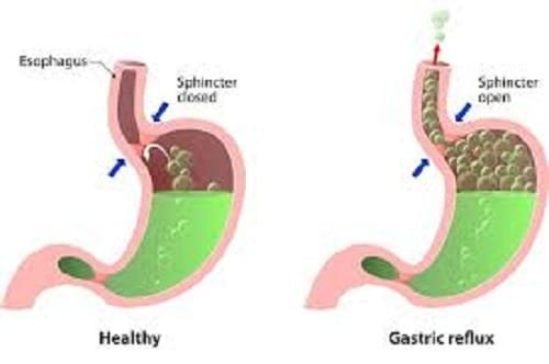 acid reflux