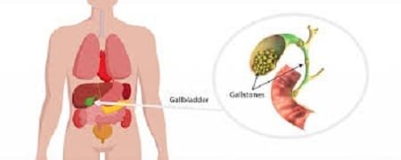 gall stone disease