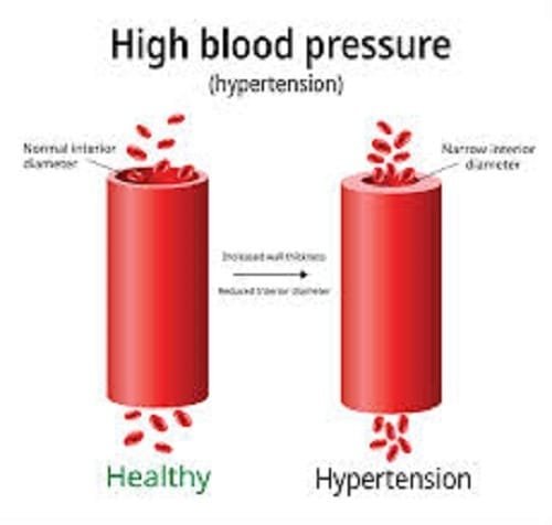 high blood pressure symptoms