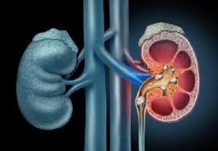 what causes kidney stones