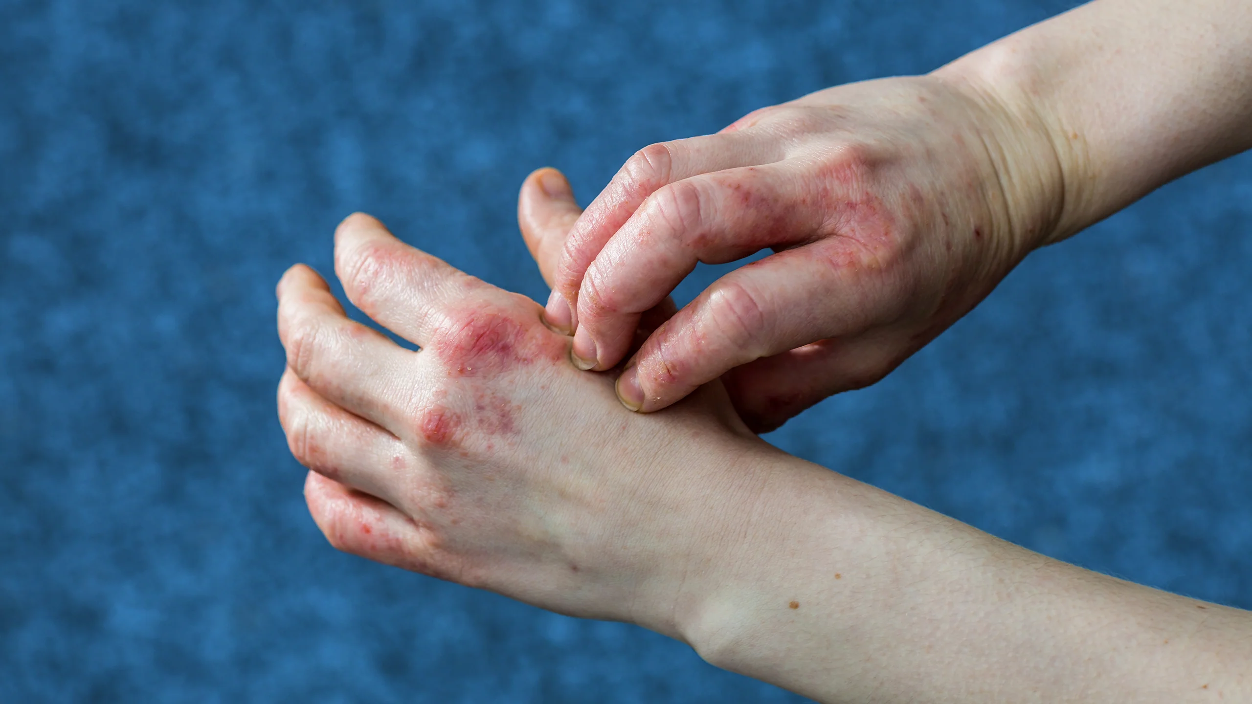 hand Eczema