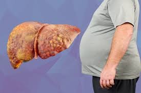 फैटी लिवर डाइट चार्ट: क्या खाएं और क्या न खाएं? - Fatty Liver Diet Chart in Hindi